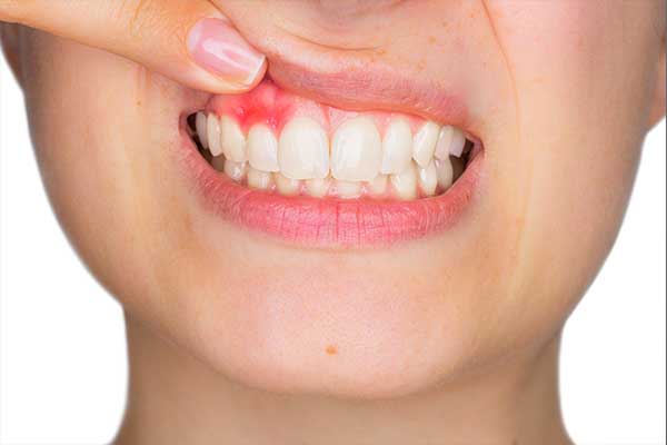 Bleeding and Swollen Gum Treatment Eltham