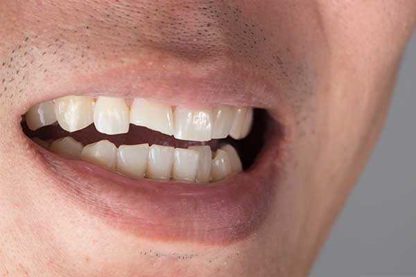 Cracked and Chipped Teeth Treatment Eltham